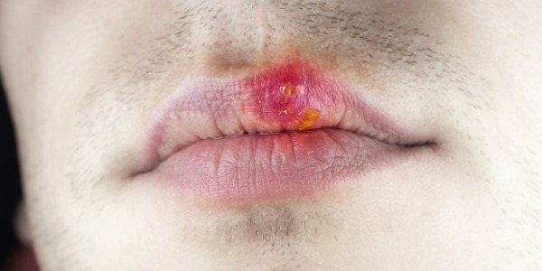 Quali sono i rimedi contro l’Herpes labiale?