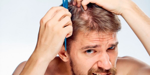 Caduta dei capelli: quando serve intervenire?