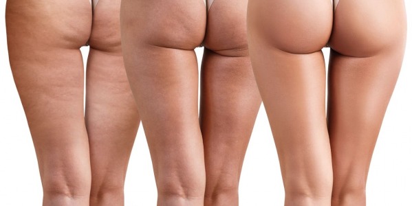 Cos'è la cellulite e come si cura?