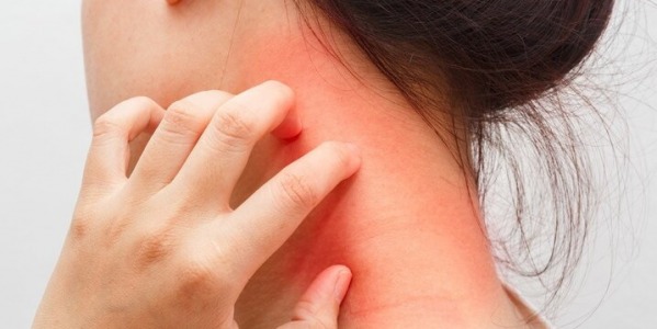 Cos'è la dermatite e come si cura?
