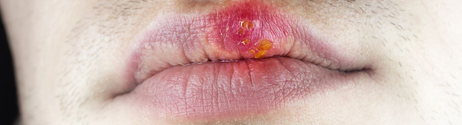 Quali sono i rimedi contro l'Herpes labiale? - Mediafarma