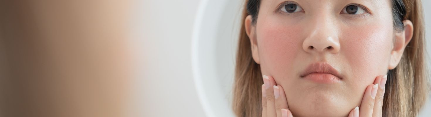 Rosacea: come prendersi cura delle macchie rosse sul viso