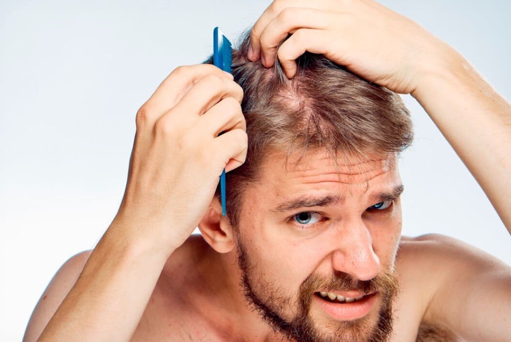 Caduta dei capelli: quando serve intervenire?