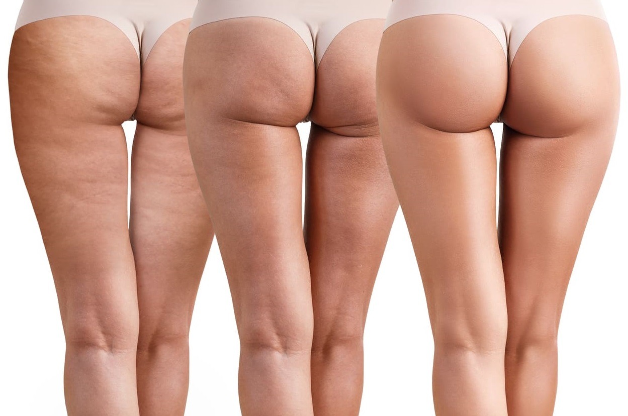 Cos'è la cellulite e come si cura?