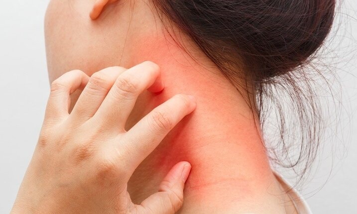 Cos'è la dermatite e come si cura?
